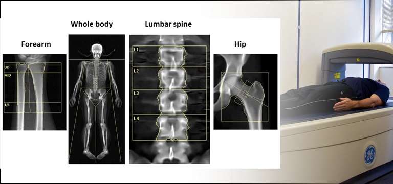 What is Bone Density Test? What Conditions is Bone Density Scan used in?